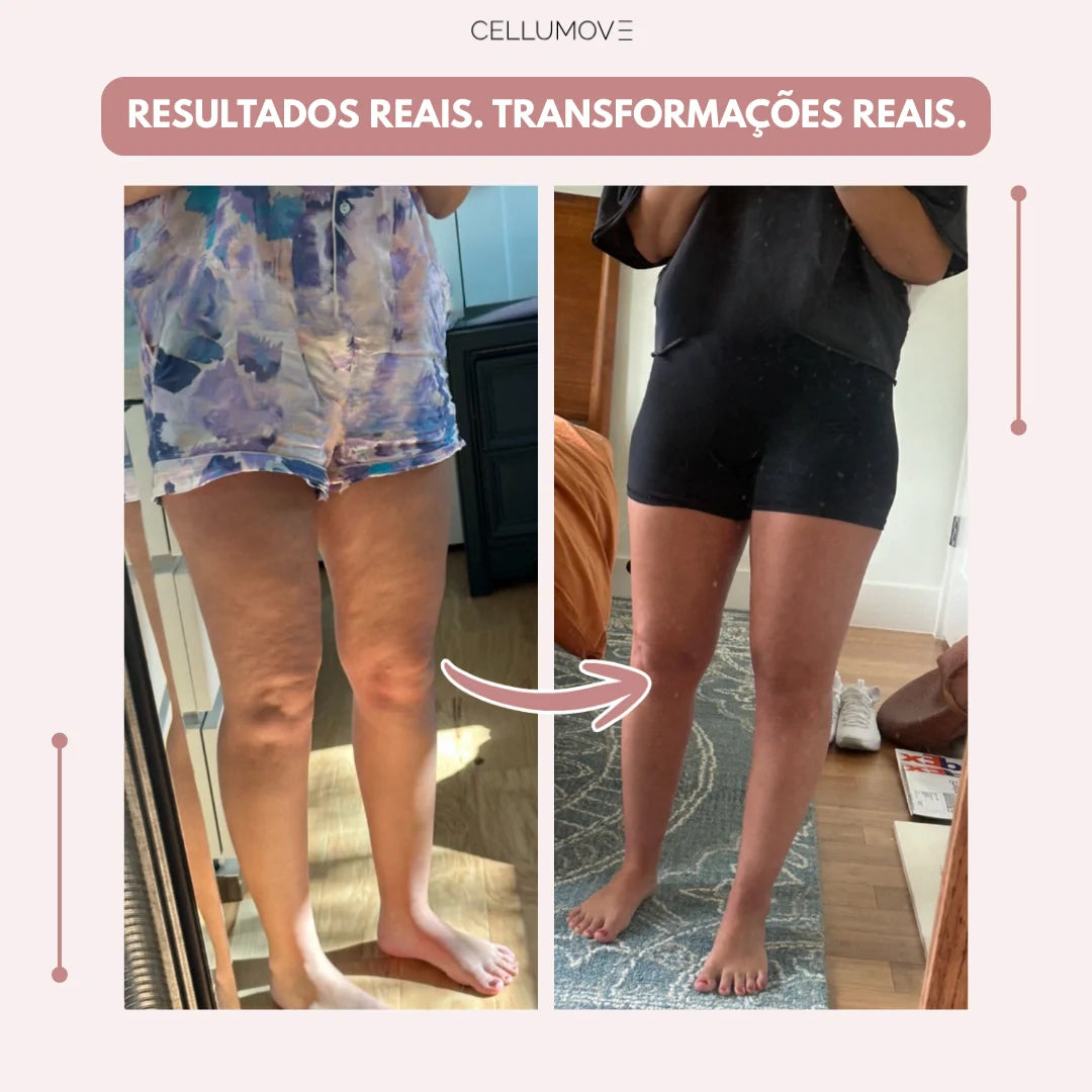 Legging Cellumove 3D – Diga adeus à dor e ao inchaço do lipedema de forma natural