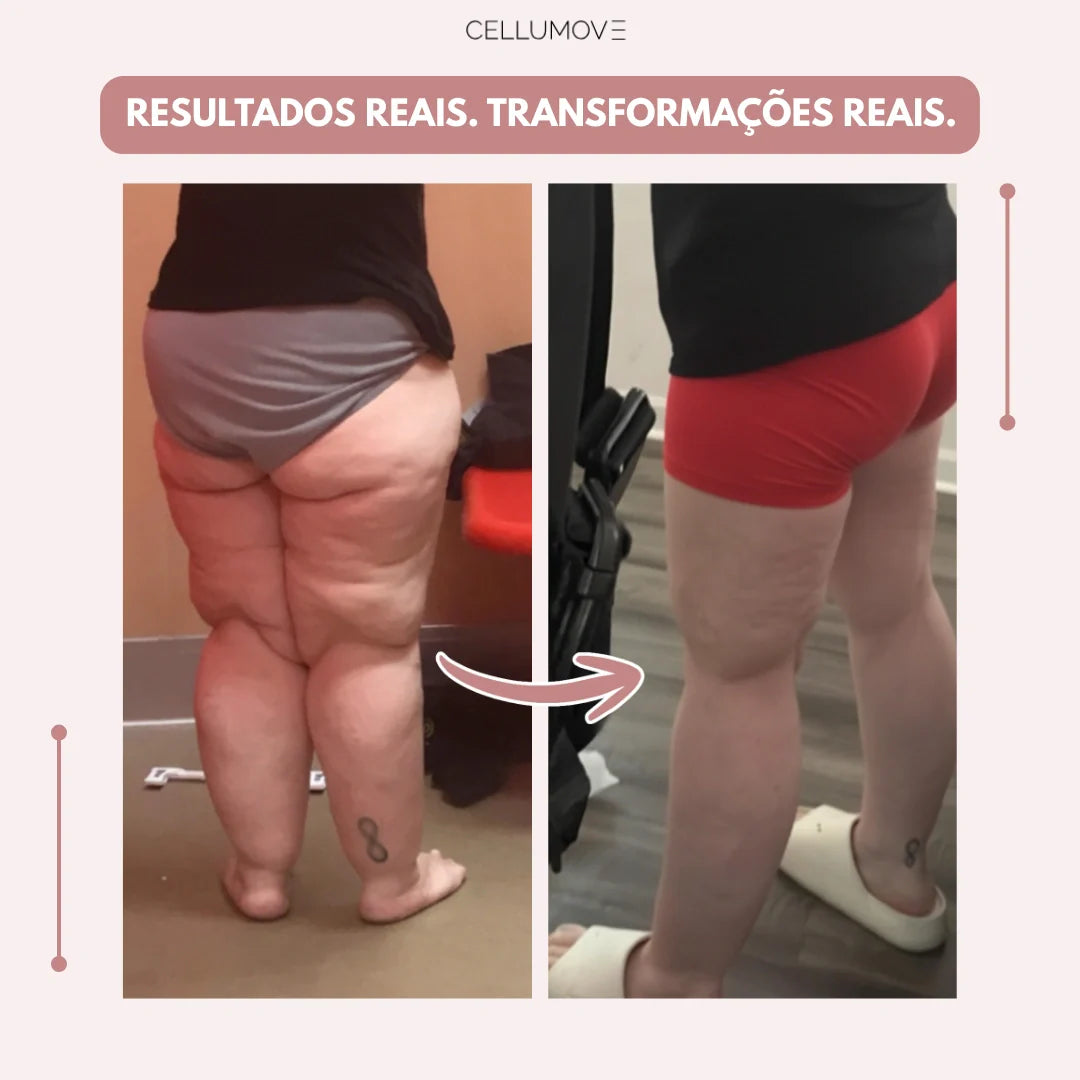 Legging Cellumove 3D – Diga adeus à dor e ao inchaço do lipedema de forma natural