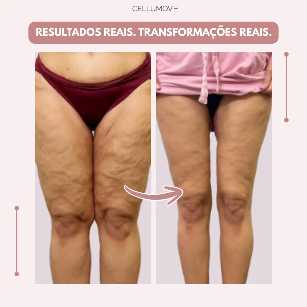 Legging Cellumove 3D – Diga adeus à dor e ao inchaço do lipedema de forma natural