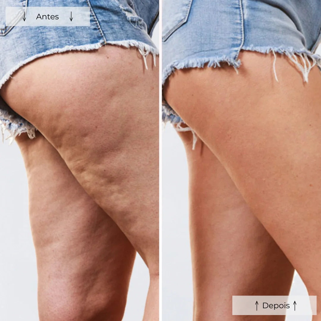 Terapia com Luz Vermelha Cellumove - Elimine a Celulite em 28 Dias
