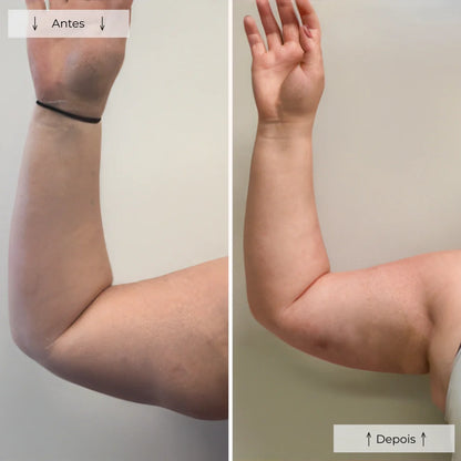 Terapia com Luz Vermelha Cellumove - Elimine a Celulite em 28 Dias