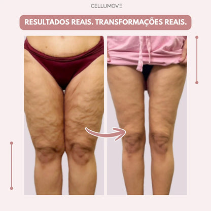 Legging Cellumove 3D – Diga adeus à dor e ao inchaço do lipedema de forma natural